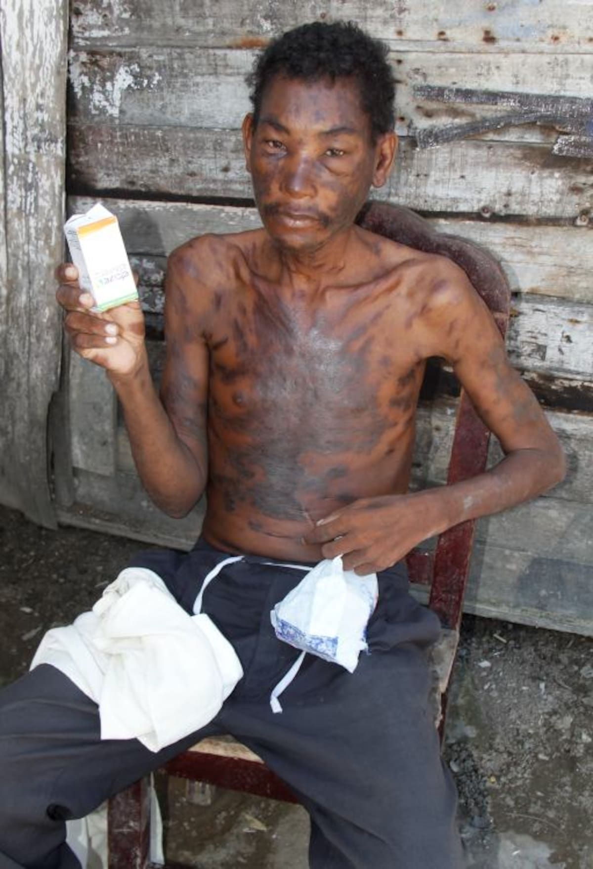 Pedro Cáceres sobrevive con los medicamentos, alimentos y demás ayudas que sus vecinos del barrio San Francisco, en medio de su propia pobreza, le ofrecen. Las manchas en su piel, hacen pensar que podría haber contraído alguna enfermedad adicional. KAILLINE GIRALDO-EL UNIVERSAL