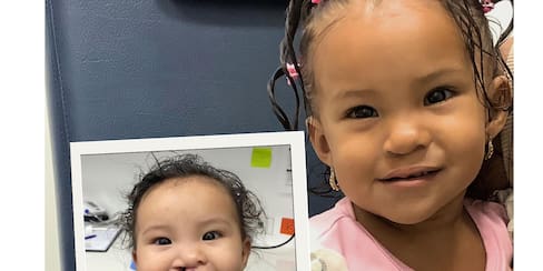 ¡Qué buena noticia! Cirugías gratuitas para niños con labio y paladar hendido