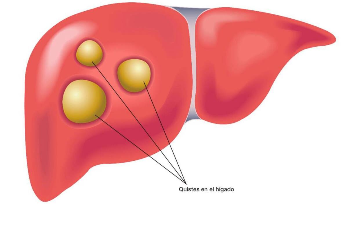 Medicina adaptada: la esperanza de pacientes con colangiocarcinoma