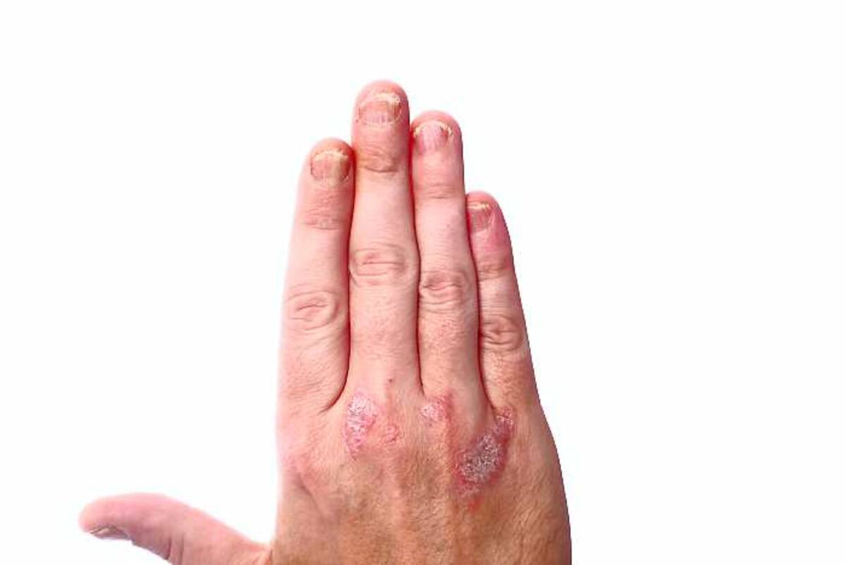 La falta de vitamina E produce consecuencias como desgaste en las uñas. 123 ROYALTY FREE