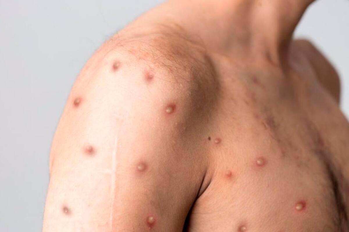 Ojo: viruela del mono provocaría problemas en el corazón