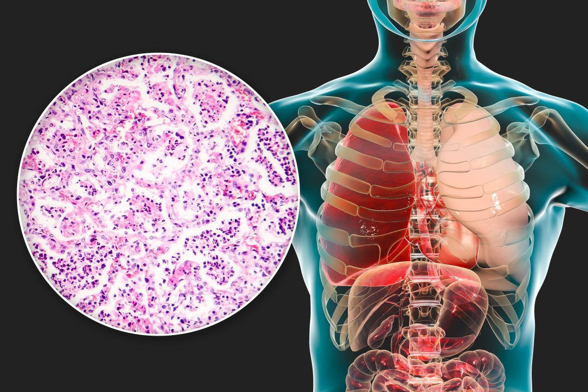 Mexicanos crean prueba que con calor detecta cáncer de mama