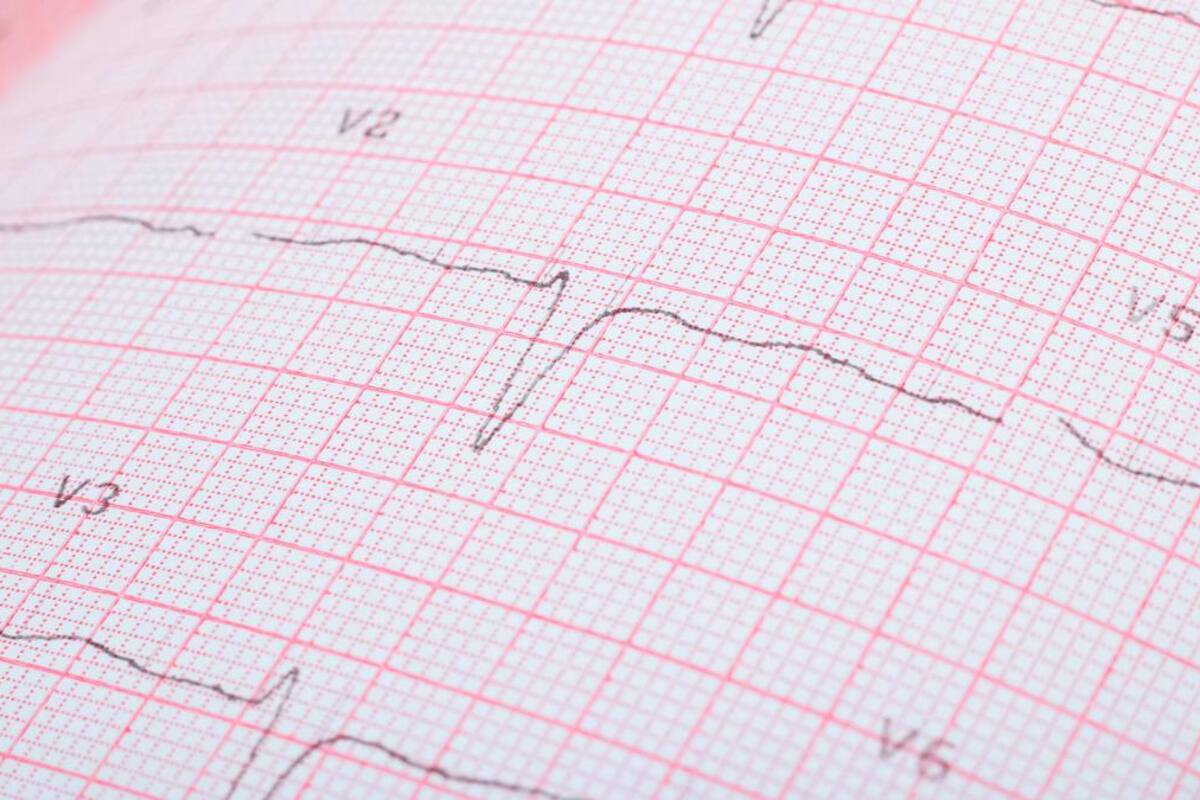 Fibrilación auricular: cuando el ritmo cardiaco normal se pierde