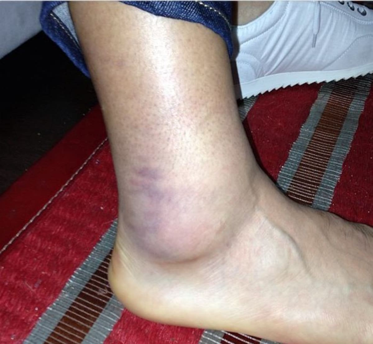 Falcao García publicó en la red social Twitter una fotografía que muestra el estado de su tobillo.