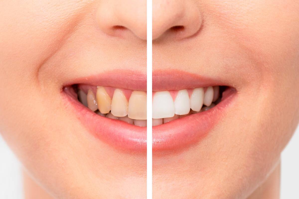 Blanqueamiento dental, no es agresivo, pero sí de cuidado