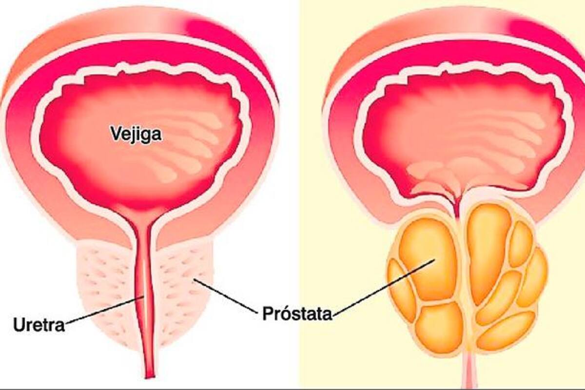 Nuevo tratamiento contra el cáncer de próstata