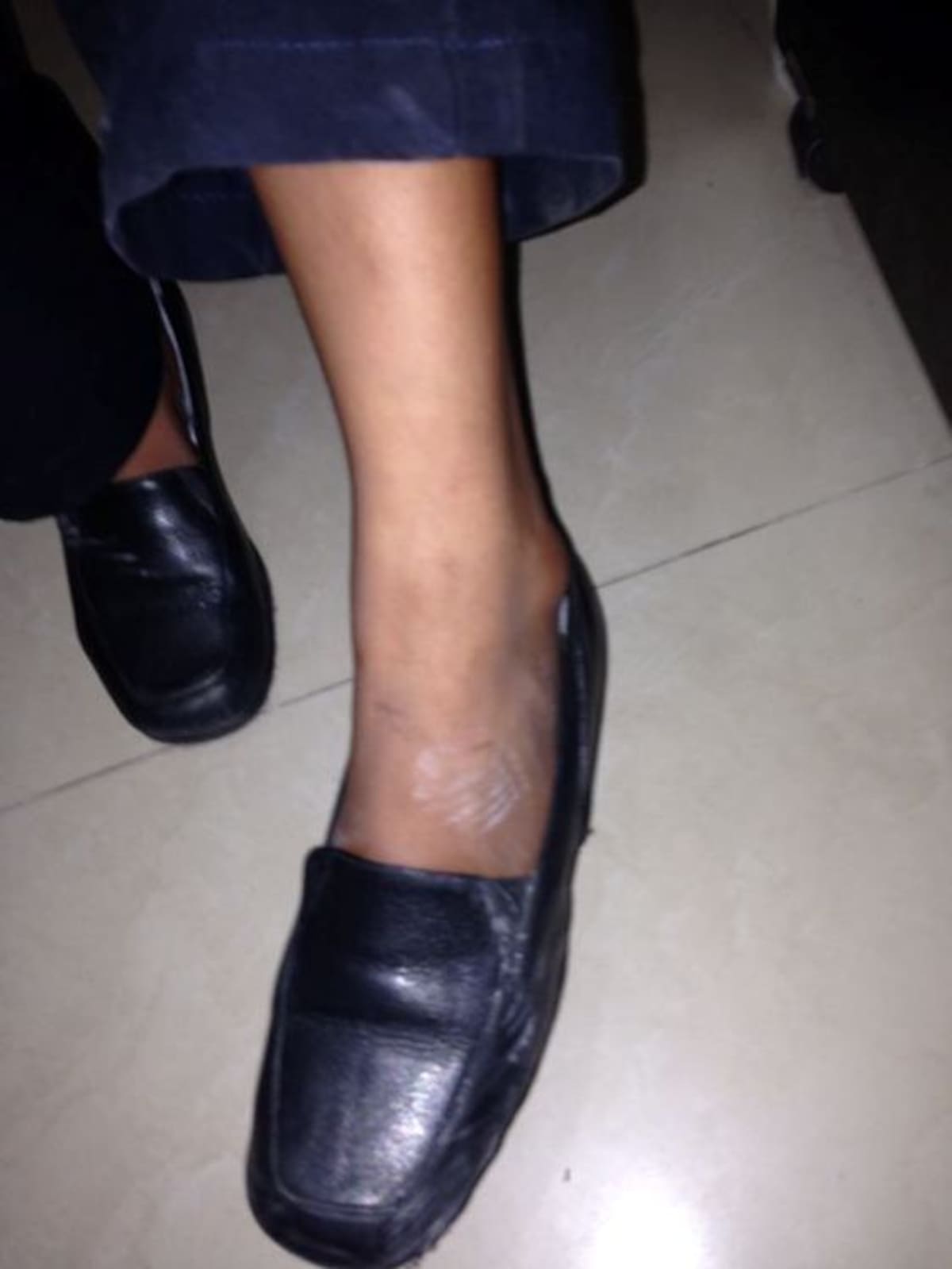 Pie en le que resultó afectada la joven de 20 años. El Teso