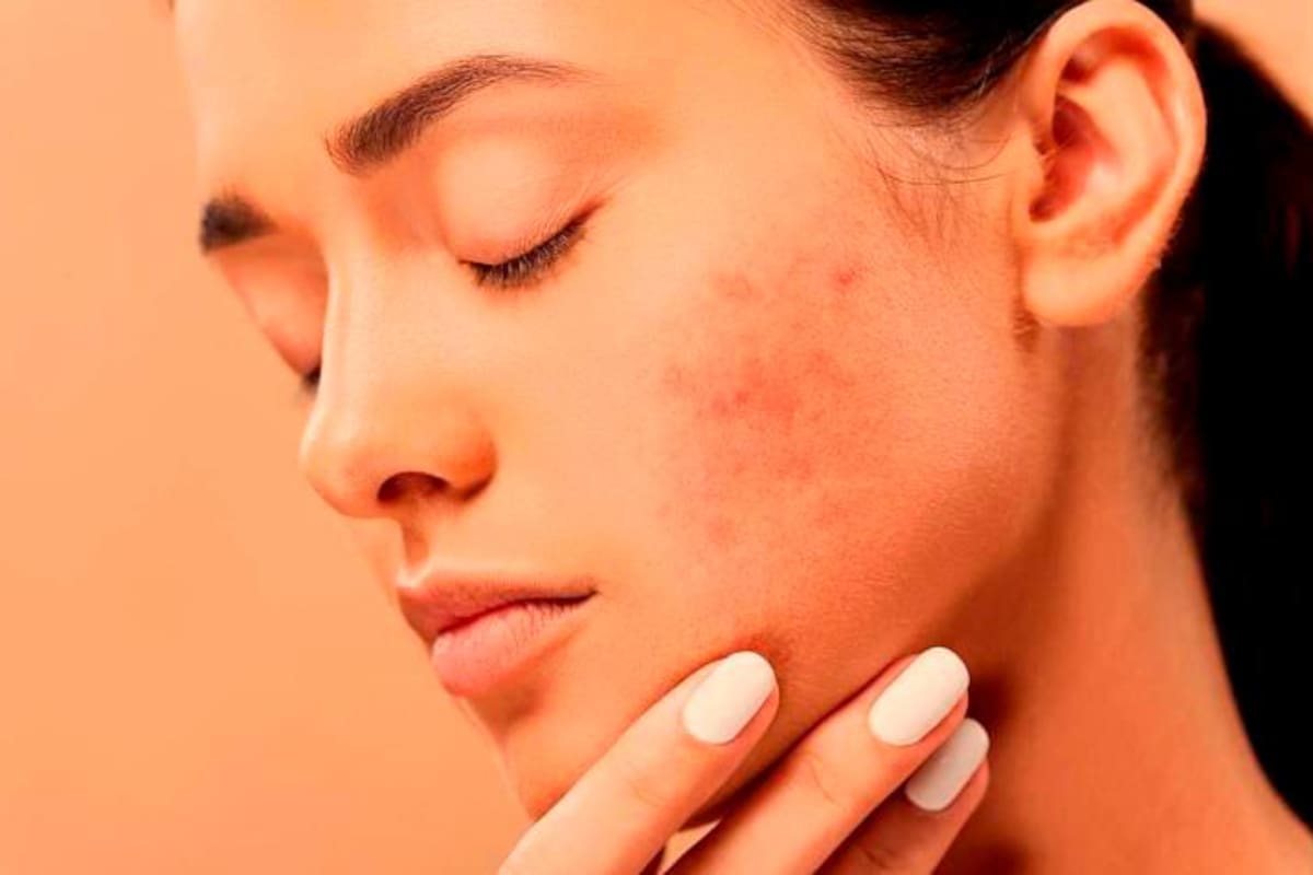 Enfermedades de la piel: ¿Qué es la hidradenitis supurativa?
