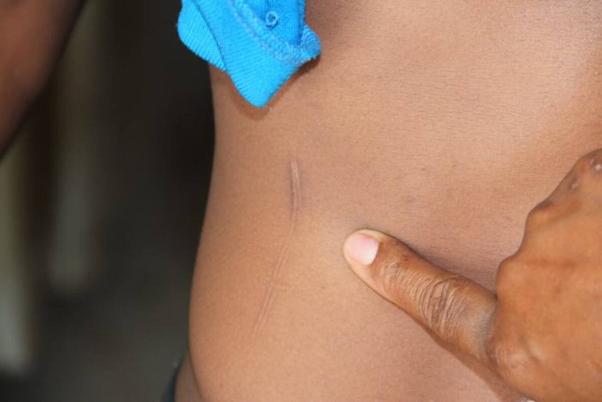 Ocaris Barón muestra una cicatriz que tiene su hijo en la espalda y asegura que esta es producto de las agresiones de los uniformados contra su hijo. ElUniversal.com.co