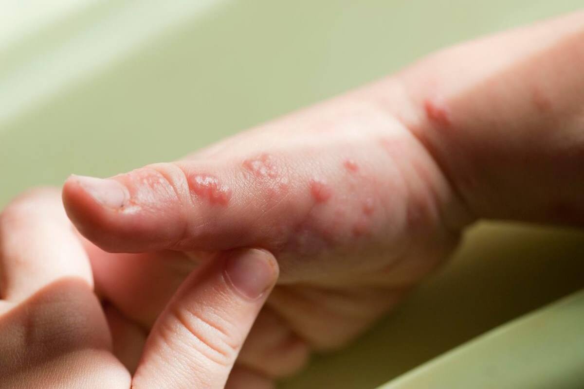 La viruela del mono no se convertirá en una pandemia como la COVID-19