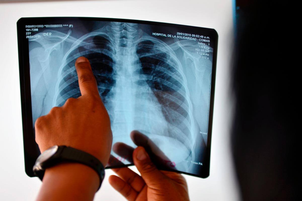 Urgente: la Unión Africana y la OMS piden medidas para la tuberculosis