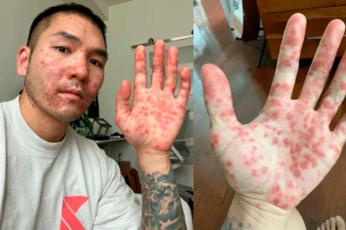 Un hombre fue diagnosticado con herpes y sarna por error, era viruela del mono