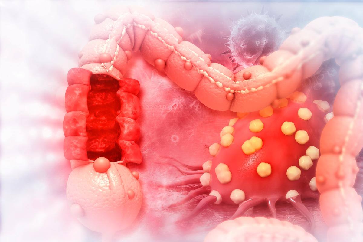Nuevo tratamiento cura a doce personas con cáncer de recto