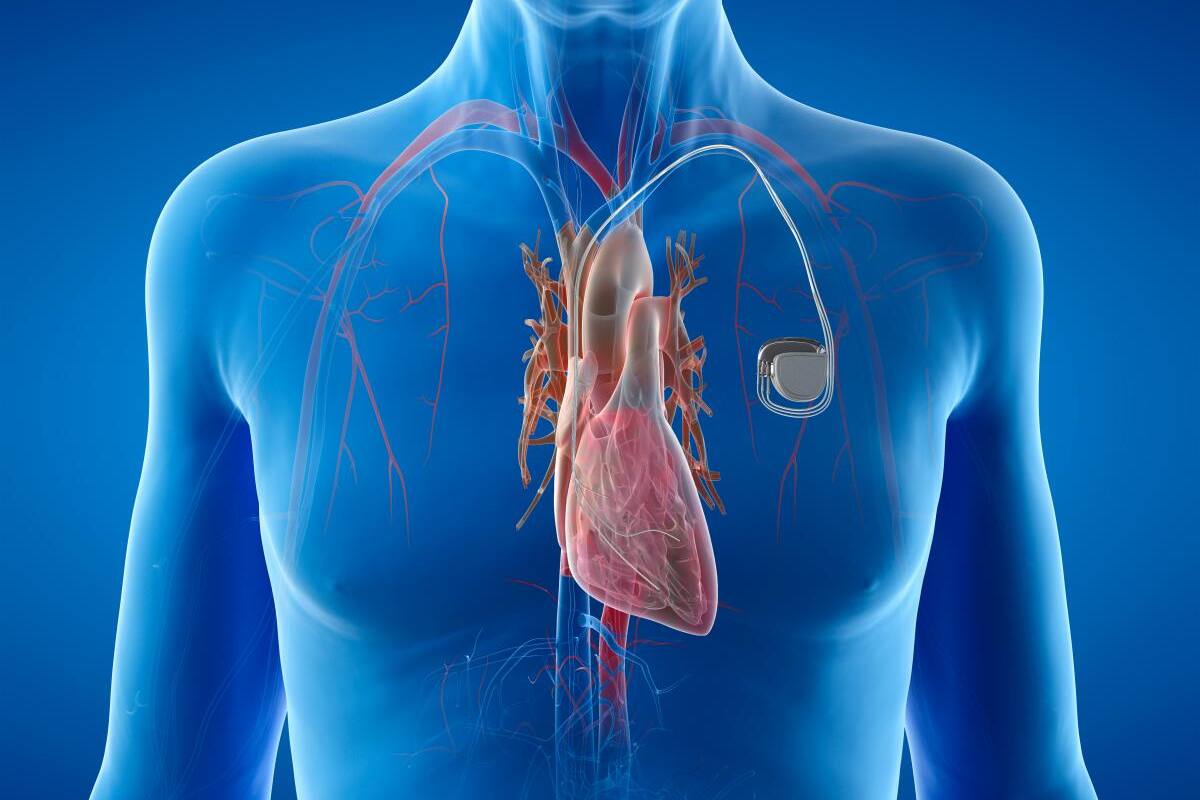 Pacientes en Colombia se benefician del marcapasos más pequeño del mundo