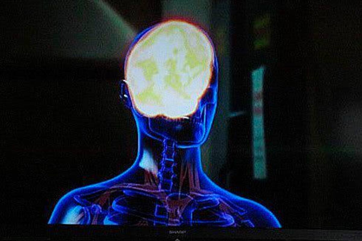 Estos son los factores de riesgo genético del alzheimer