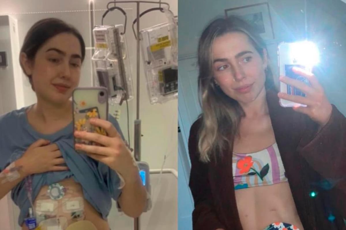 ¡Iba al baño 30 veces al día! Enfermedad la obliga a usar bolsa de ostomía