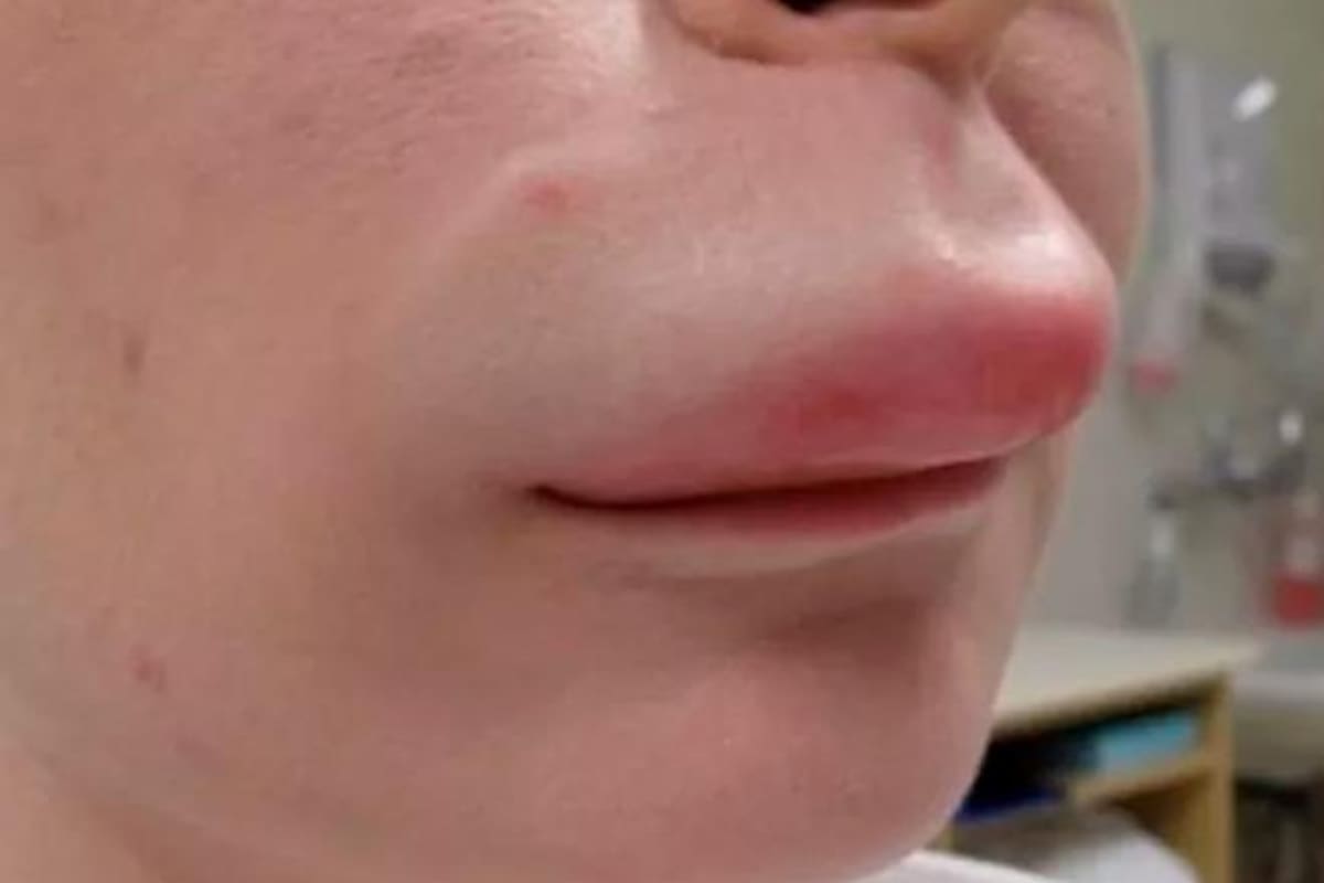 Día de las Enfermedades Huérfanas: conoce el angioedema hereditario