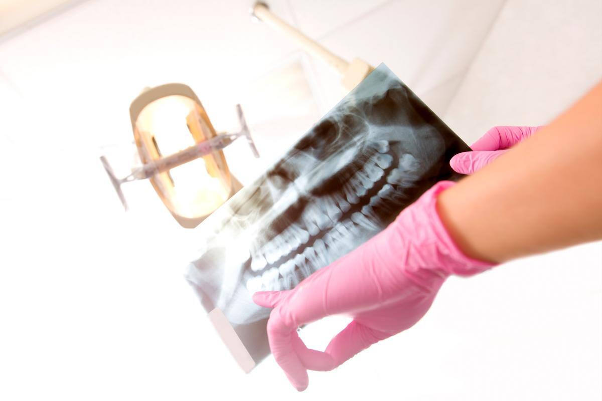 La diabetes debilita los dientes y favorece la aparición de caries