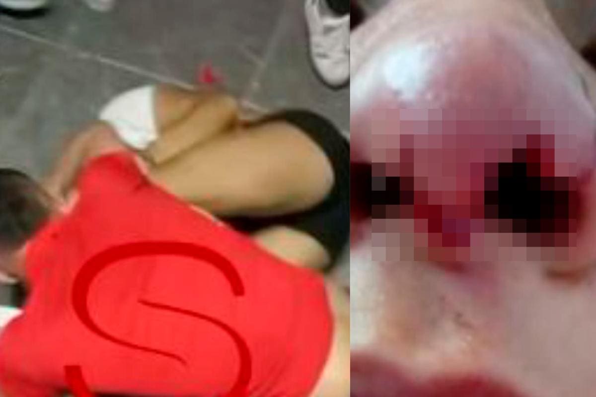 A mordiscos hombre le arrancó parte de la nariz a mujer en un estadero