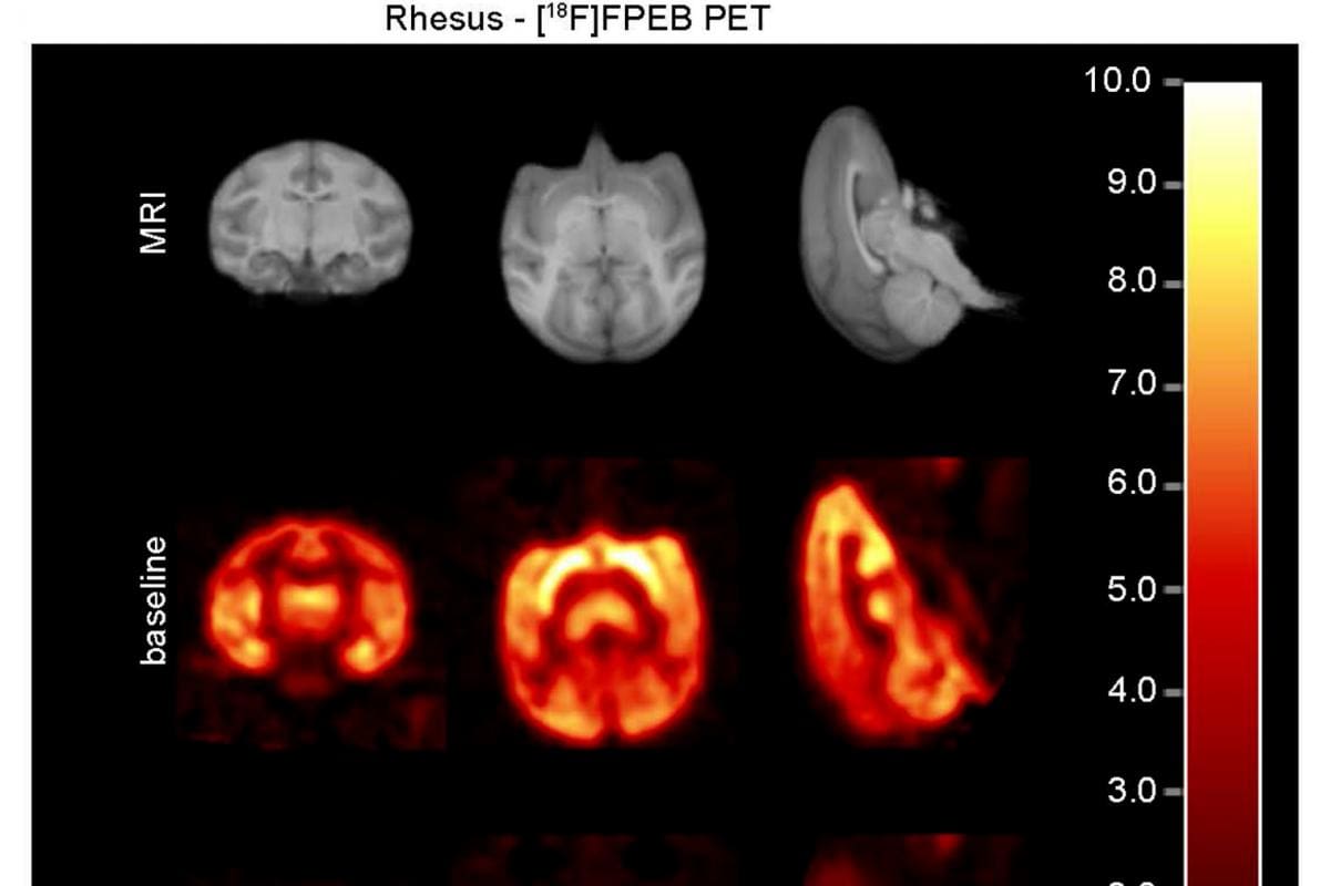 El compuesto que revierte los daños del alzhéimer en las neuronas