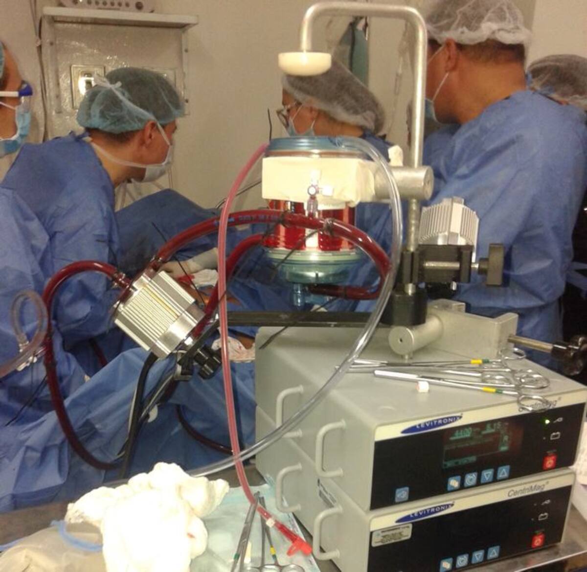 El ECMO (Membrana de Oxigenación Extracorporea), cumple las funciones del pulmón (oxigenación de la sangre), mientras dicho órgano se recupera. Cortesía