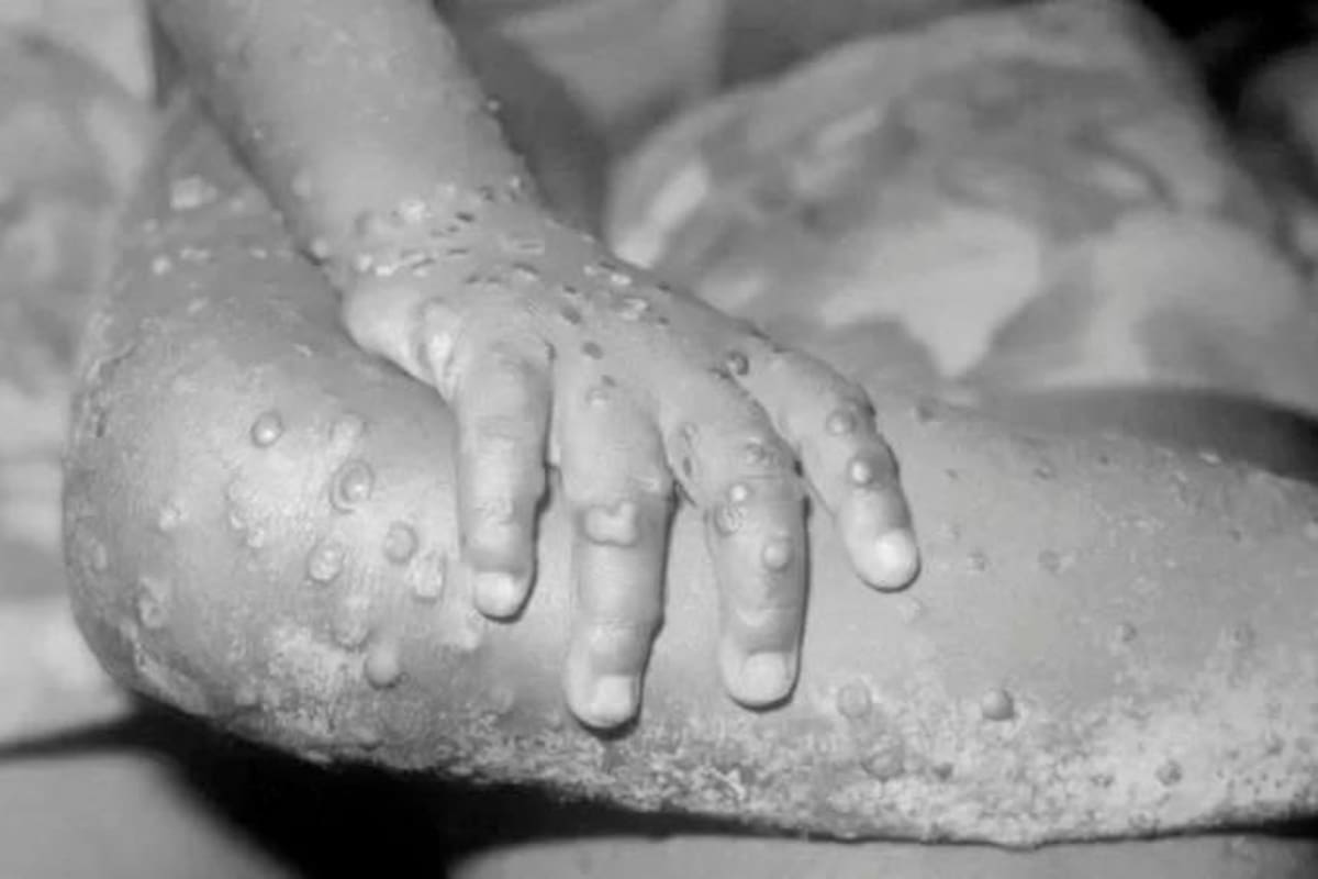 ¿Qué es la viruela del mono?, la enfermedad que se extiende en Europa