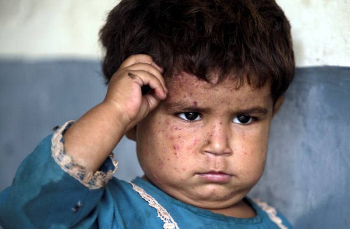 La imagen corresponde a una niña pakistaní que sufrió múltiples picaduras. AP