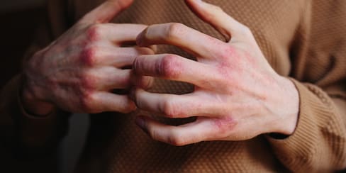 Así influye el clima de Cartagena en la dermatitis atópica: síntomas y tratamiento