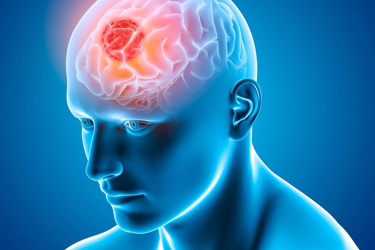 Científicos crean un tumor cerebral activo en 3D