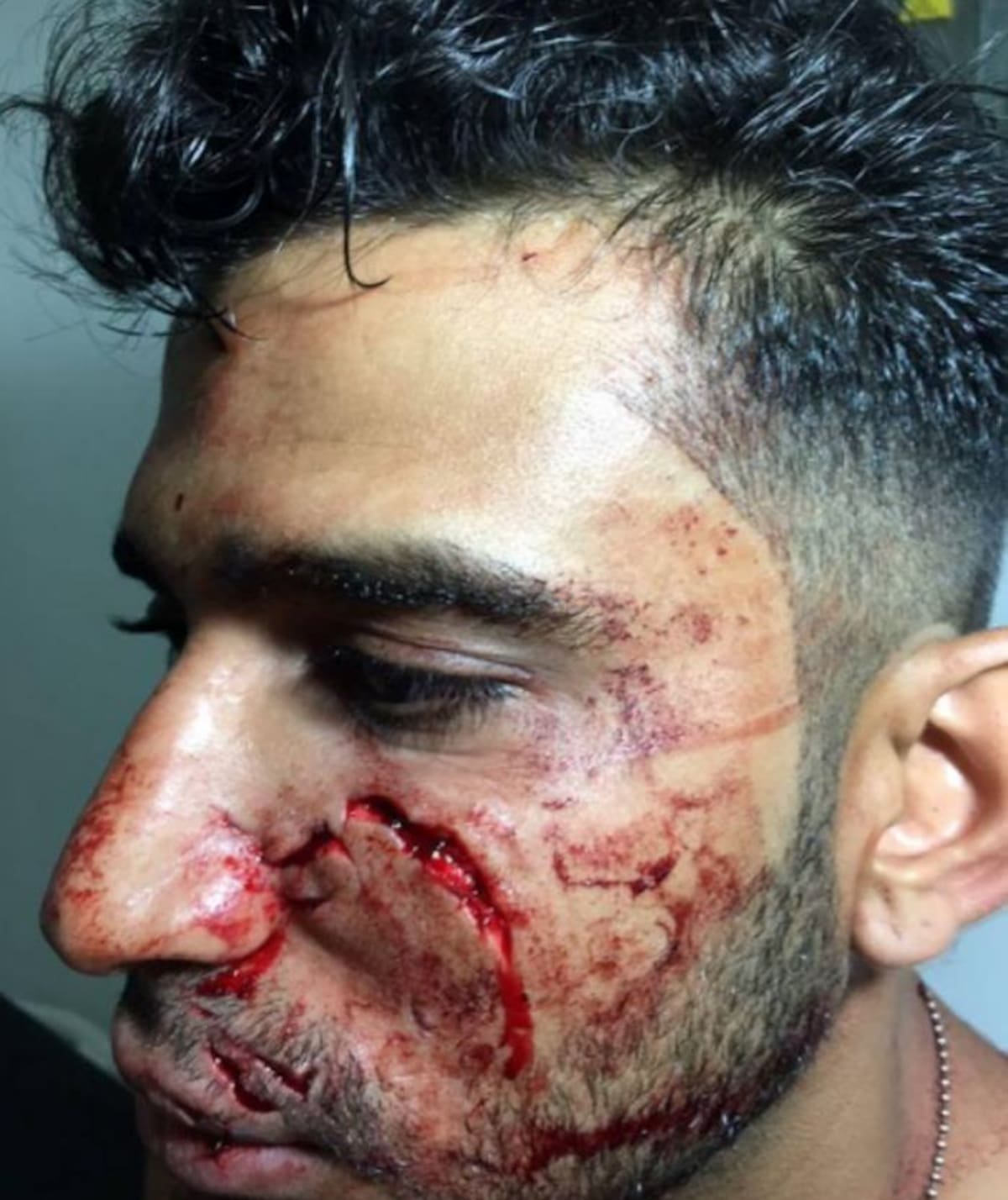 José David Ibarra Sosa deberá ser nuevamente intervenido quirúrgicamente en seis meses.