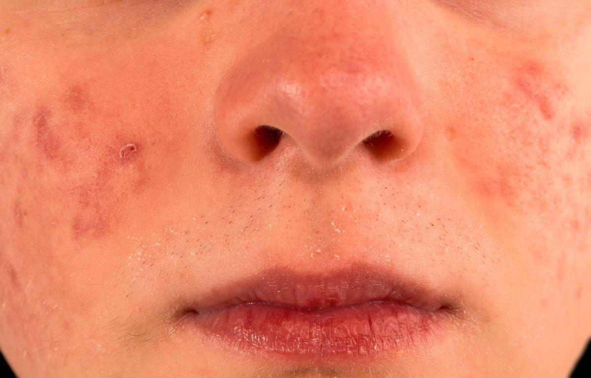 El estudio COVID Piel, ha realizado la primera clasificación de los síntomas cutáneos que presentan los pacientes con Covid-19. // Foto: 123RF.