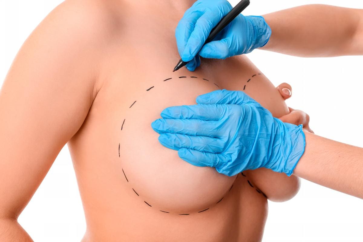 Mamoplastia: tres consejos para escoger un implante mamario