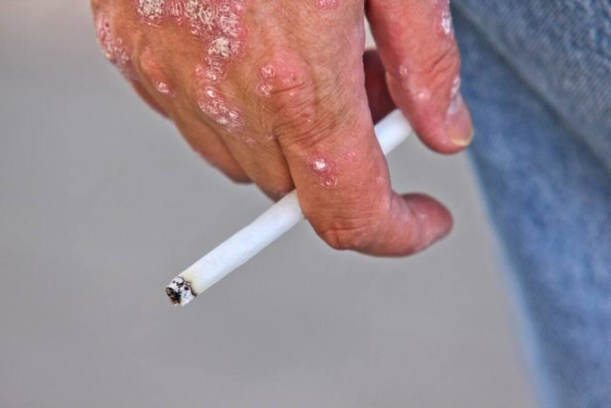 Fumar se vincula con mayor riesgo de desarrollar psoriasis, así que considere dejar de fumar, tanto por la enfermedad como por su salud general. 123RF.
