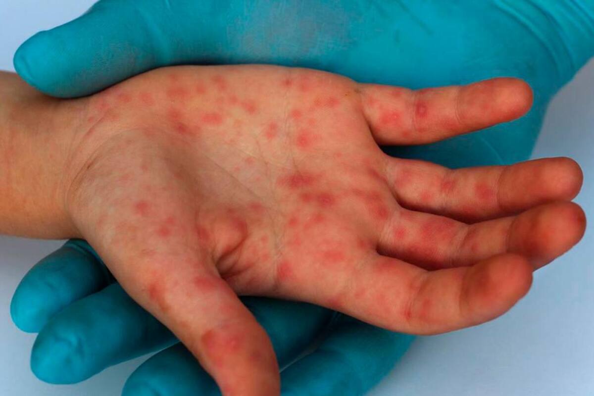 Un hombre da positivo en VIH, coronavirus y viruela del mono a la vez