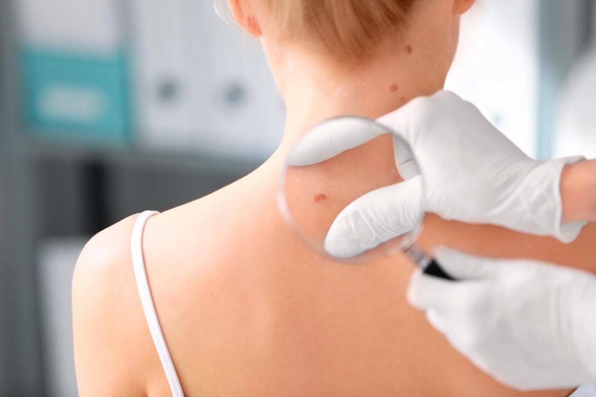Información, clave contra cáncer de piel