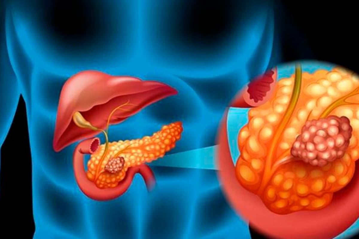 Análisis de heces: otro paso para detectar el cáncer de páncreas