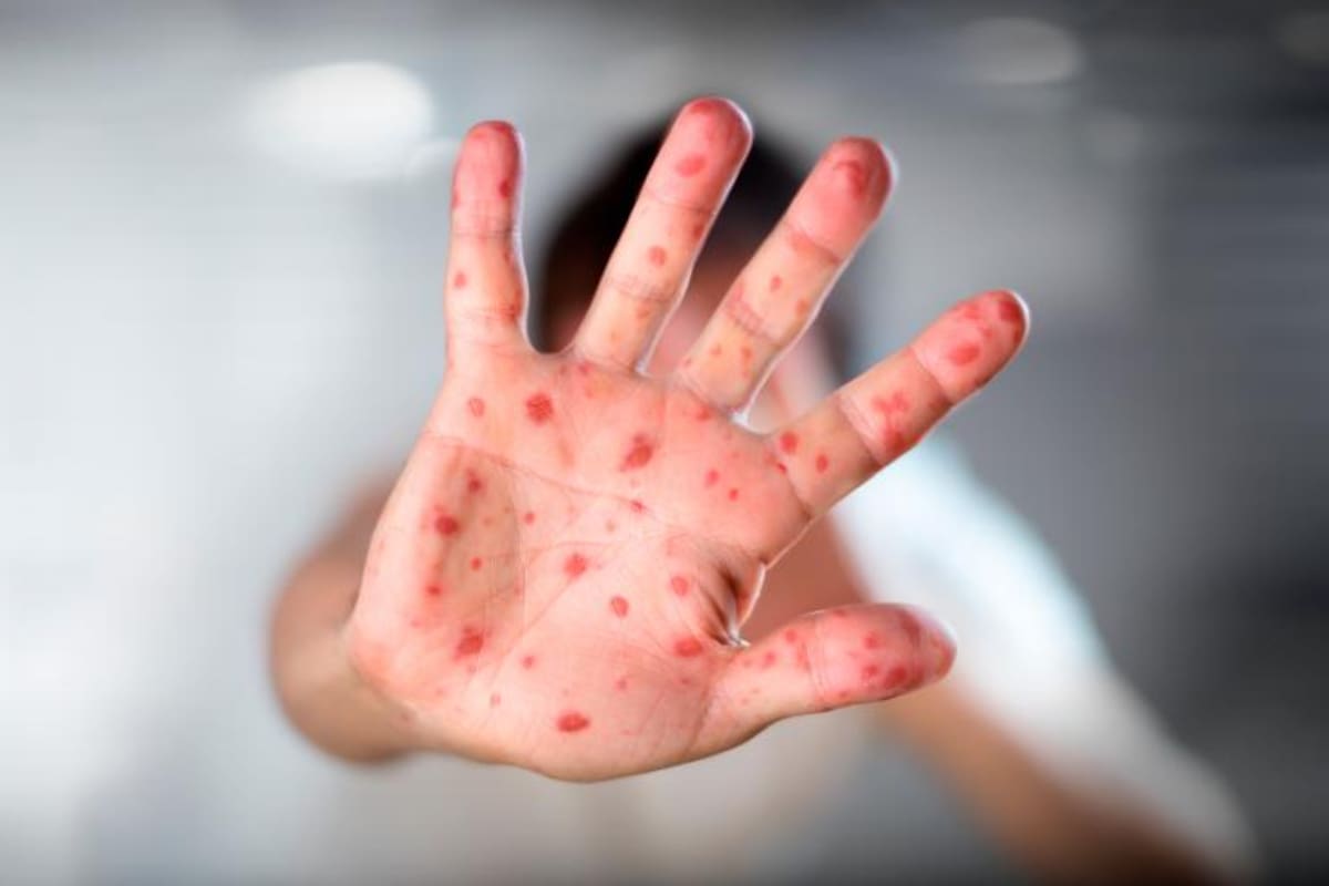 Minsalud investiga el primer caso de la viruela del mono en Colombia