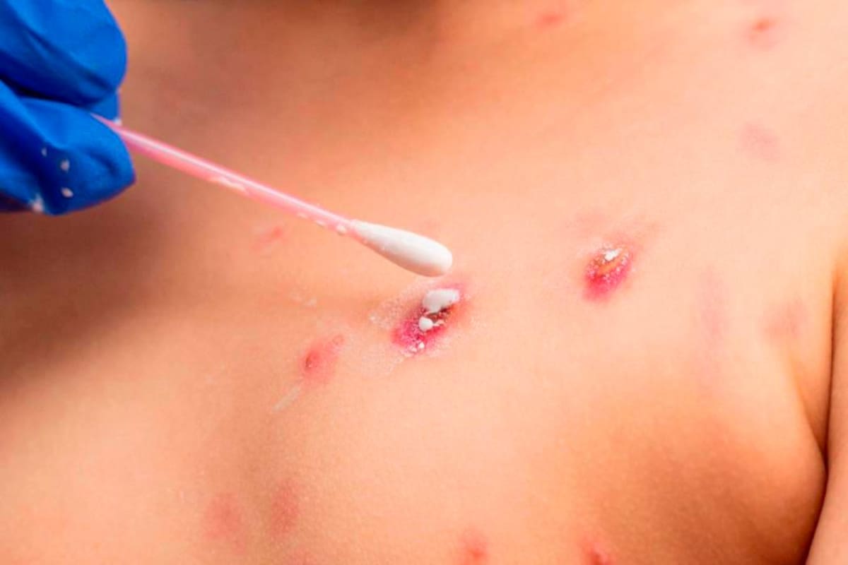 Alerta: Ministerio de Salud da detalles sobre la viruela del mono