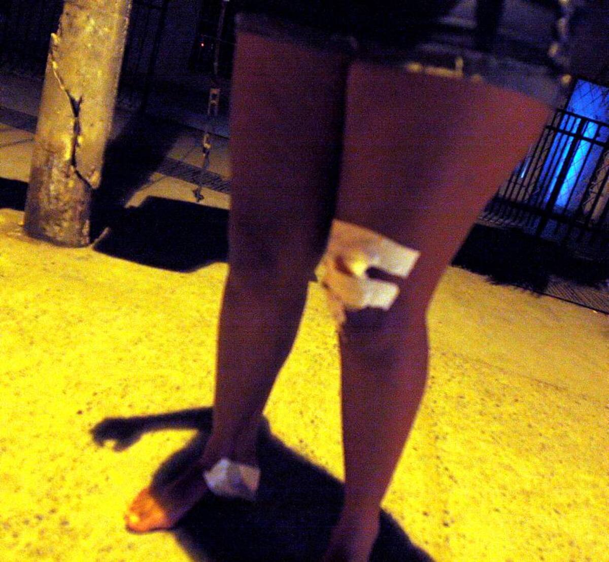 Diana Carolina de 20 años edad, resultó herida en la parte superior de su rodilla izquierda y en el talón derecho. SAMIR VARGAS - EL UNIVERSAL