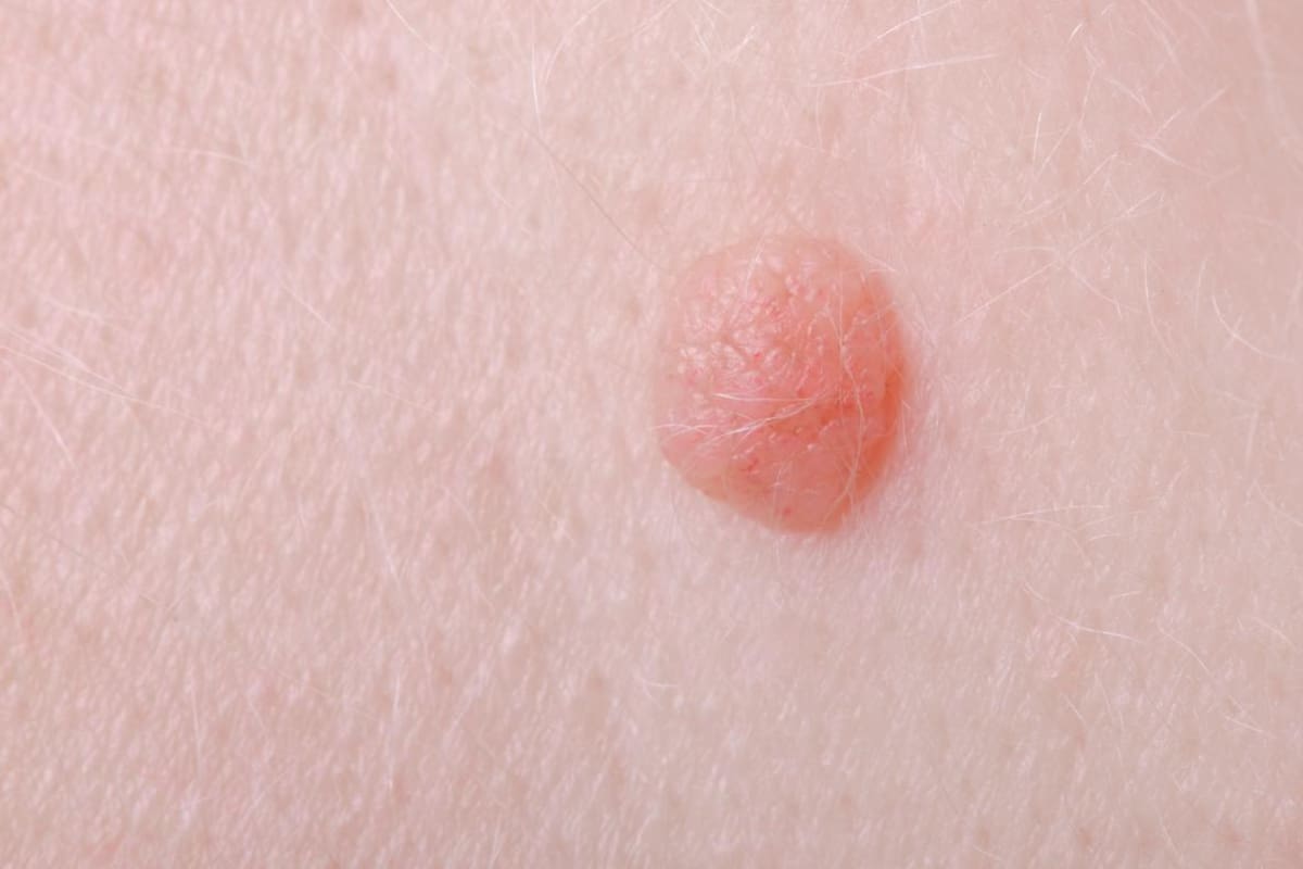 ¿Puedo saber quién me contagió del virus del papiloma humano?