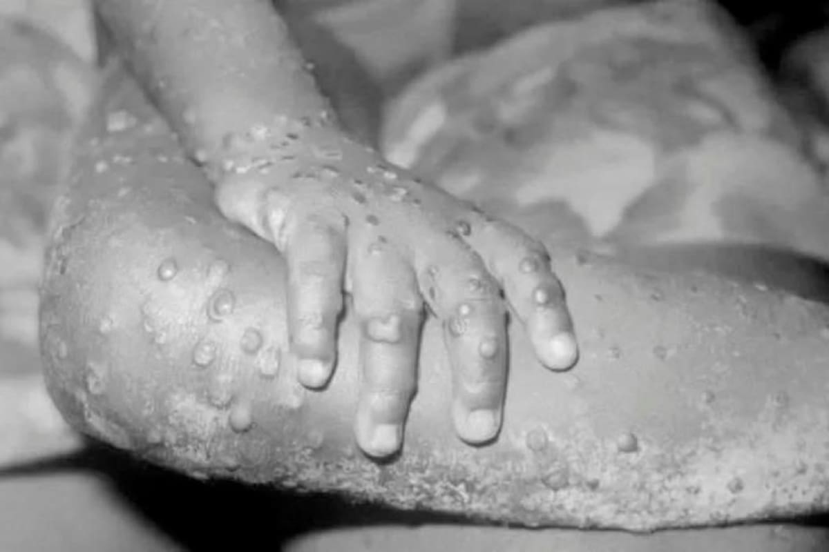 Descartan probable caso de viruela del mono en Colombia