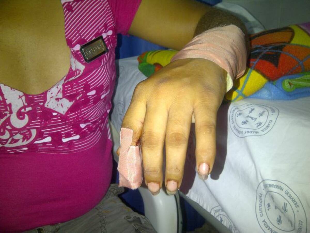 En la Clínica Madre Bernarda de Cartagena se recupera Jhosselyn Pájaro. Dice que las heridas que sufrió en su muñeca izquierda, le impiden mover los dedos.
