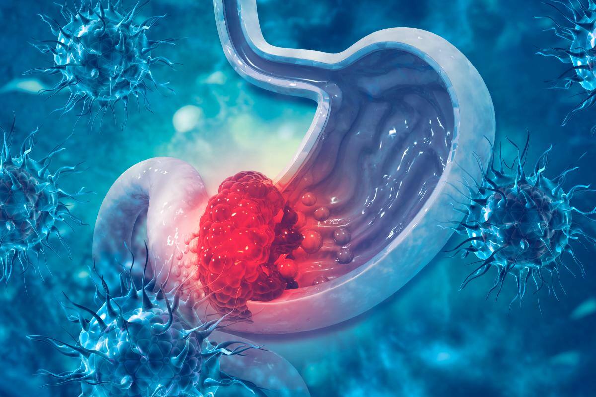 ¿Malos hábitos propician que aparezca el cáncer de estómago?