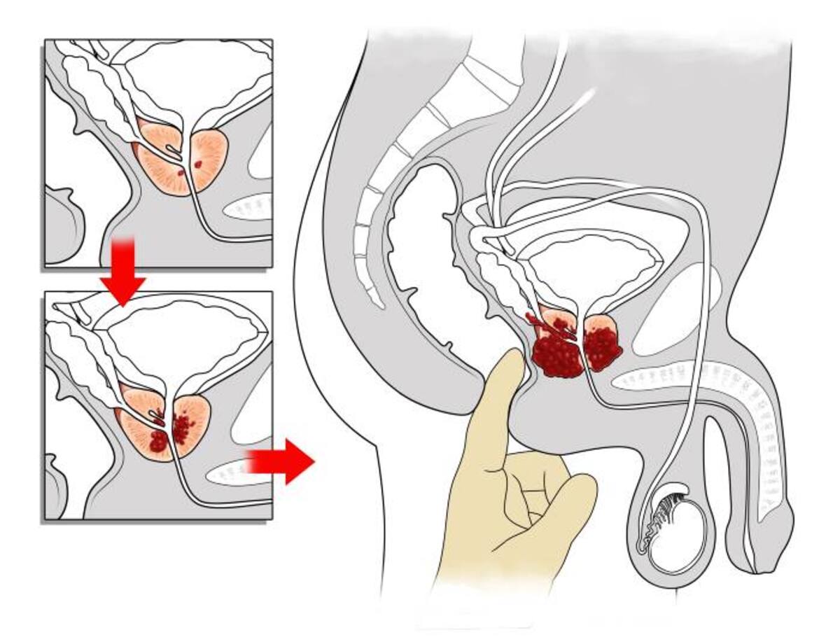 El cáncer de próstata es la segunda causa de muerte masculina en Colombia. 123 ROYALTY FREE