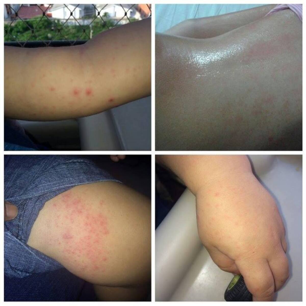 Las autoridades pidieron a la comunidad no confundir los síntomas del zika con los de otros virus.