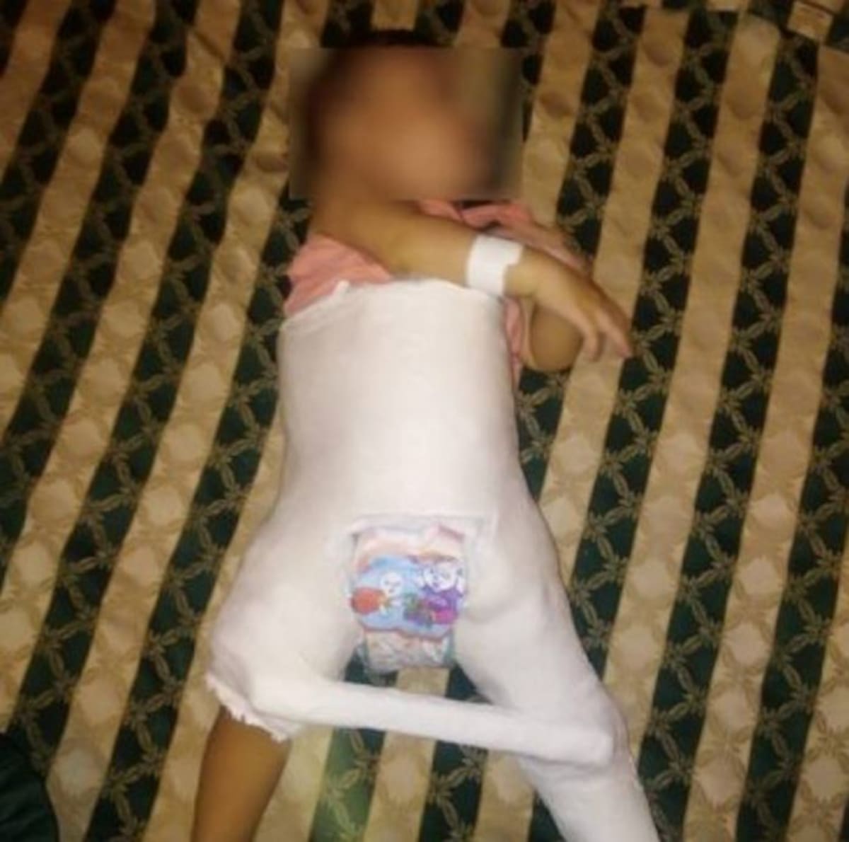 A la niña le ocasionaron una fractura en su pierna izquierda y varios contusiones menores en su cuerpo. Colprensa.