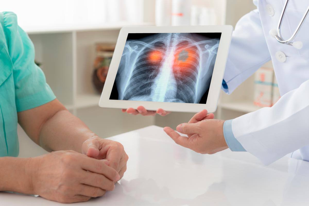 Cáncer de pulmón, una realidad que deja sin aliento