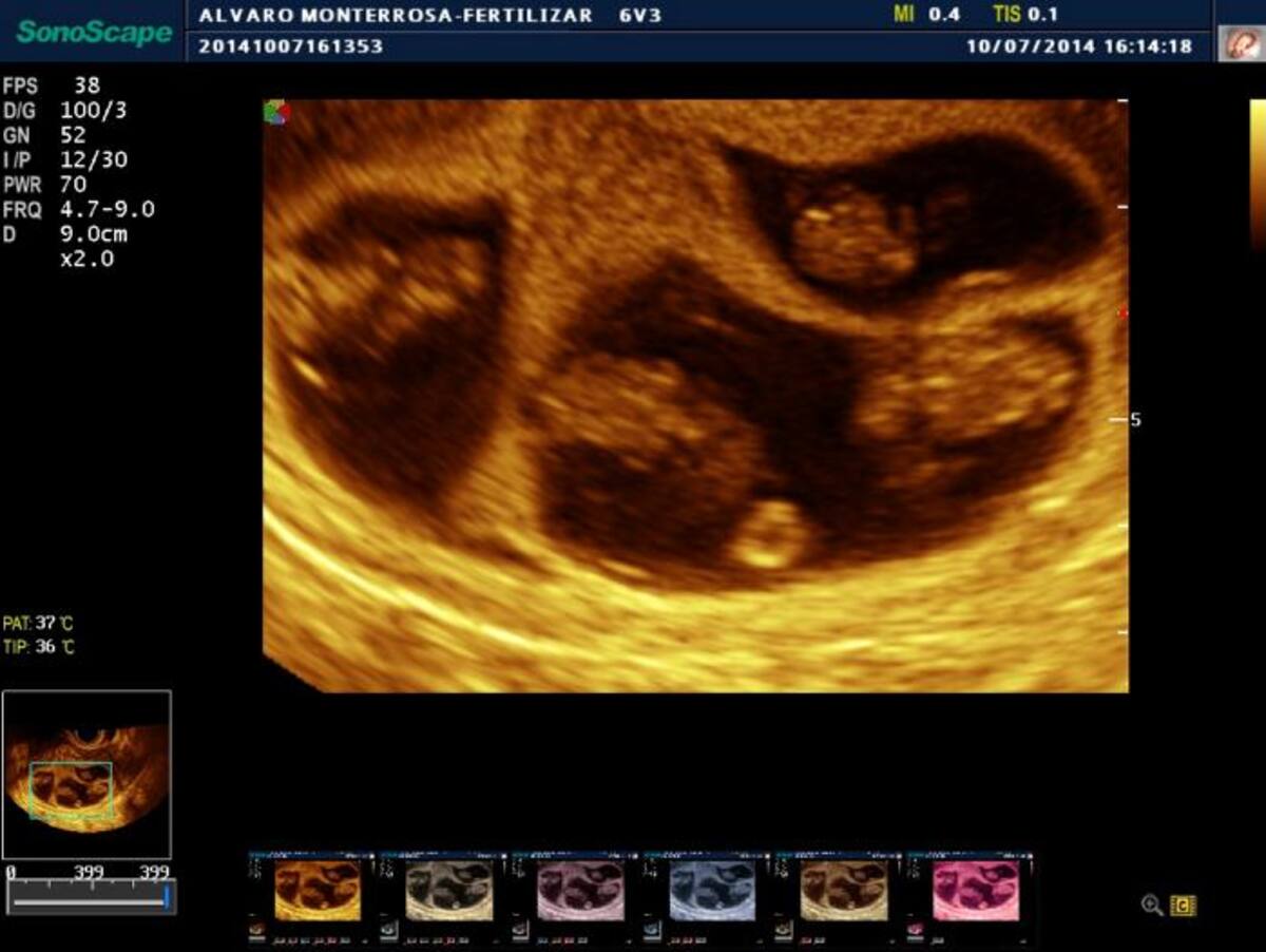 La madre de los bebés tiene 33 semanas de embarazo. Esta es una de sus primeras ecografías. Cortesía