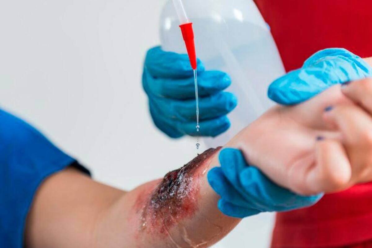 Temporada de quemaduras: evita que la pólvora arruine tu vida