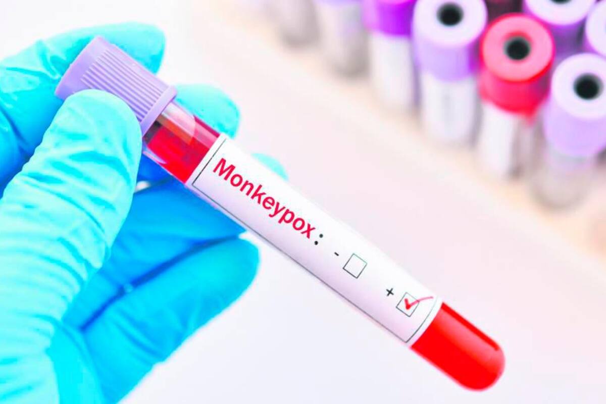 Viruela del mono: ABC del nuevo virus que llegó a Cartagena